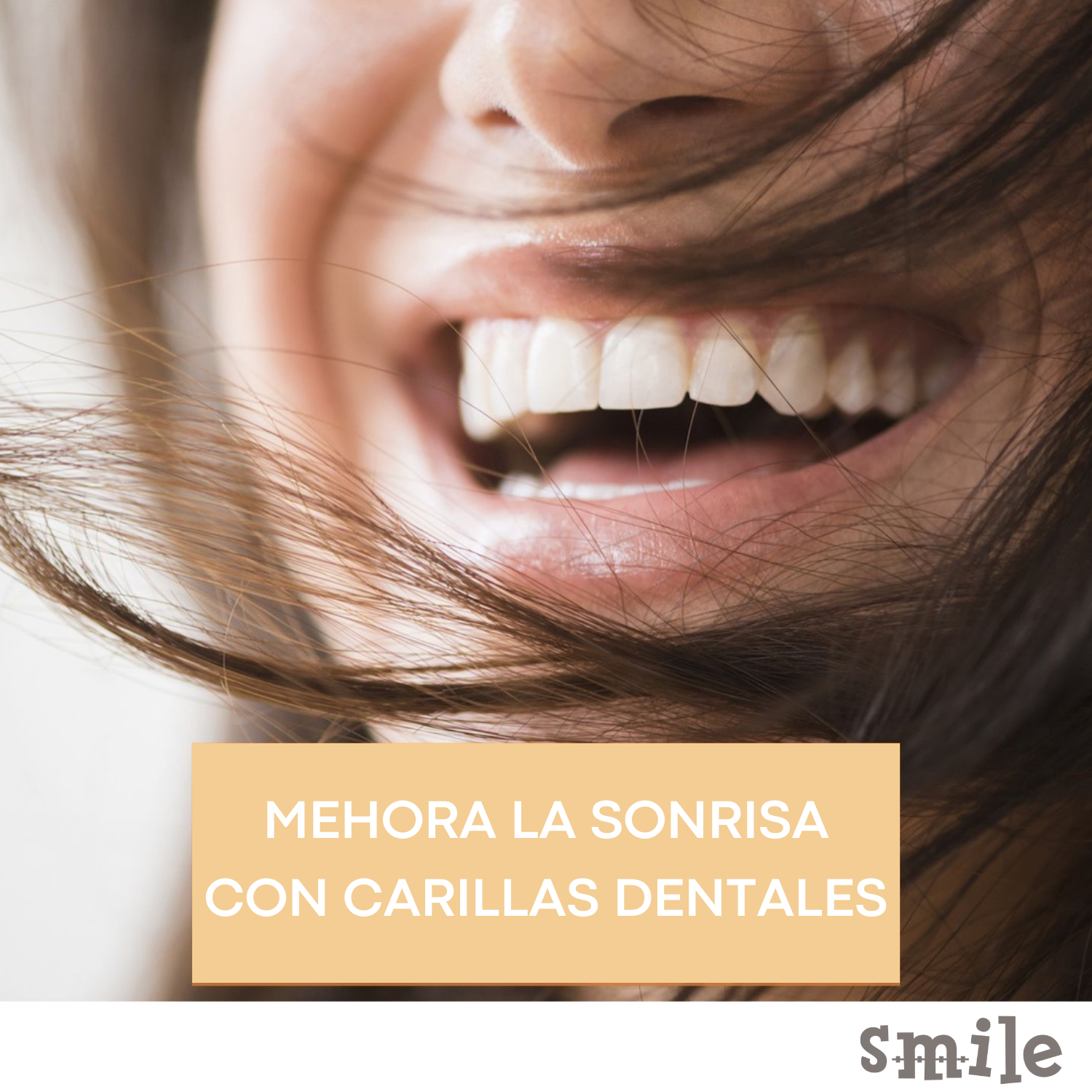 Carillas Dentales: todo lo que debes saber para mejorar el aspecto de tu  sonrisa 